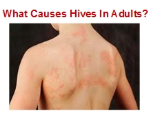 Steroids treatment for hives